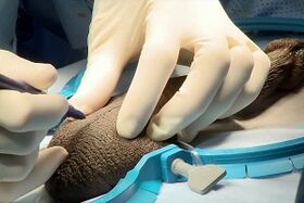 incisione del moscerino per l'ingrandimento chirurgico del pene