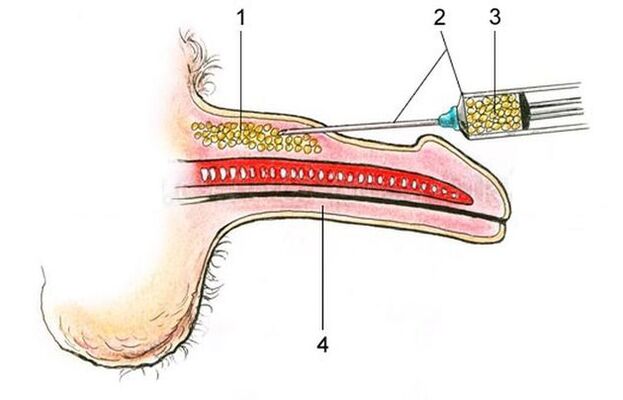 Ingrandimento del pene con iniezioni di acido ialuronico